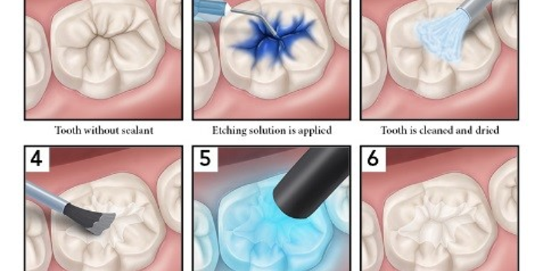 graphic showing process of dental sealants